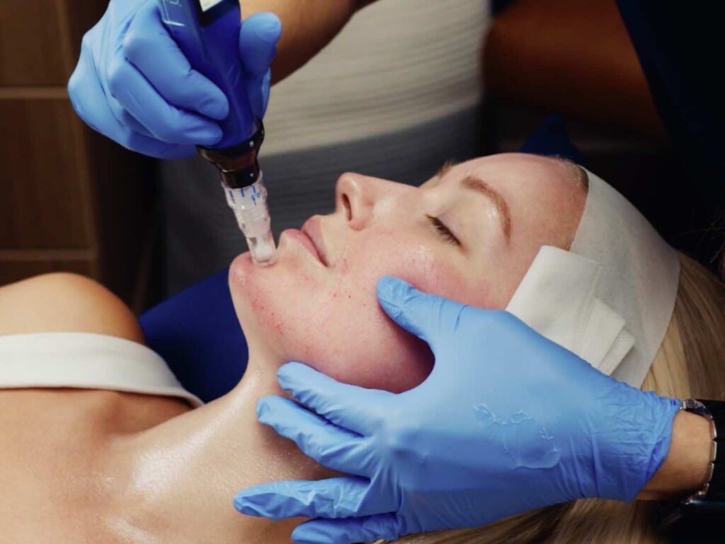 Microneedling